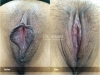 labia-minora-clitoral-hood-reduction-vitasna-technique-13