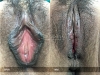 labia-minora-clitoral-hood-reduction-vitasna-technique-13