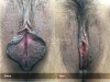 labia-minora-clitoral-hood-reduction-vitasna-technique-13