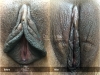 labia-minora-clitoral-hood-reduction-vitasna-technique-13
