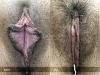 labia-minora-clitoral-hood-reduction-vitasna-technique-13