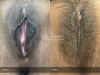 labia-minora-clitoral-hood-reduction-vitasna-technique-13