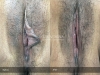labia-minora-clitoral-hood-reduction-vitasna-technique-13