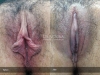 labia-minora-clitoral-hood-reduction-vitasna-technique-13