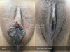 labia-minora-clitoral-hood-reduction-vitasna-technique-13