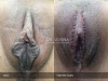 labia-minora-clitoral-hood-reduction-vitasna-technique-13