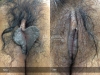 labia-minora-clitoral-hood-reduction-vitasna-technique-13